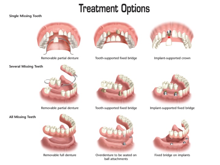 treatment for periodontal disease in elkin, NC