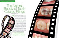 the natural beauty of tooth-colored fillings