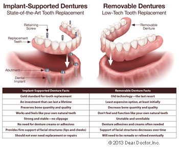 implant dentures in Elkin, NC