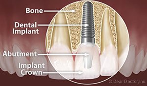 dental implant in elkin, NC