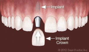 elkin, NC dental implants