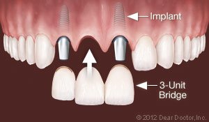multiple tooth implants in elkin, NC