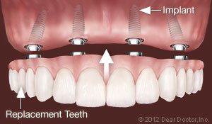 multiple teeth dental implants in elkin, NC