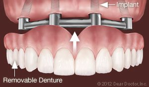 traditional denture implants in elkin, NC