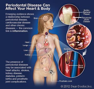 periodontal disease and health in elkin, NC