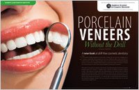 porcelain veneers without a drill
