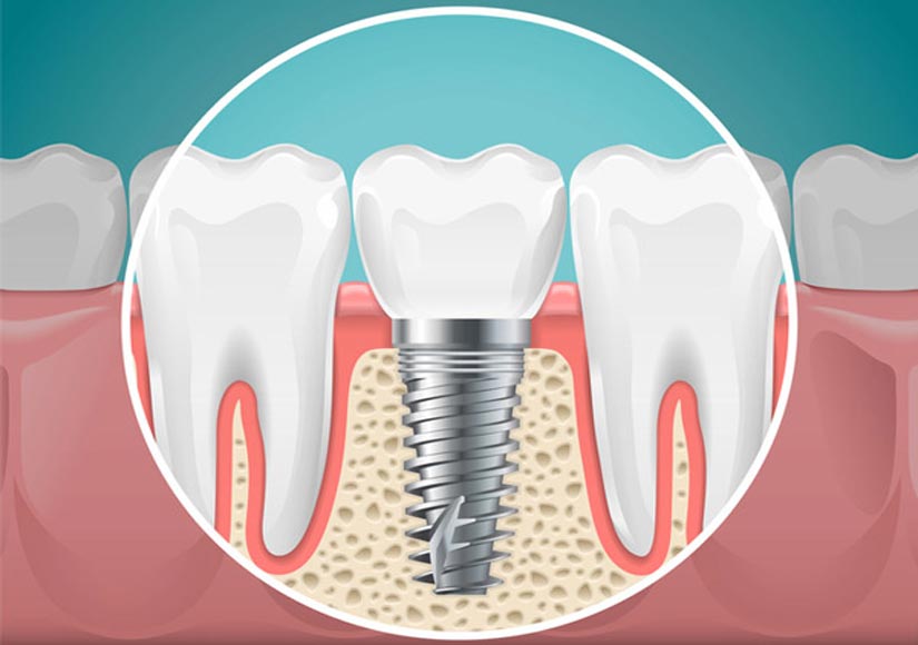 dental implant cost in elkin, NC