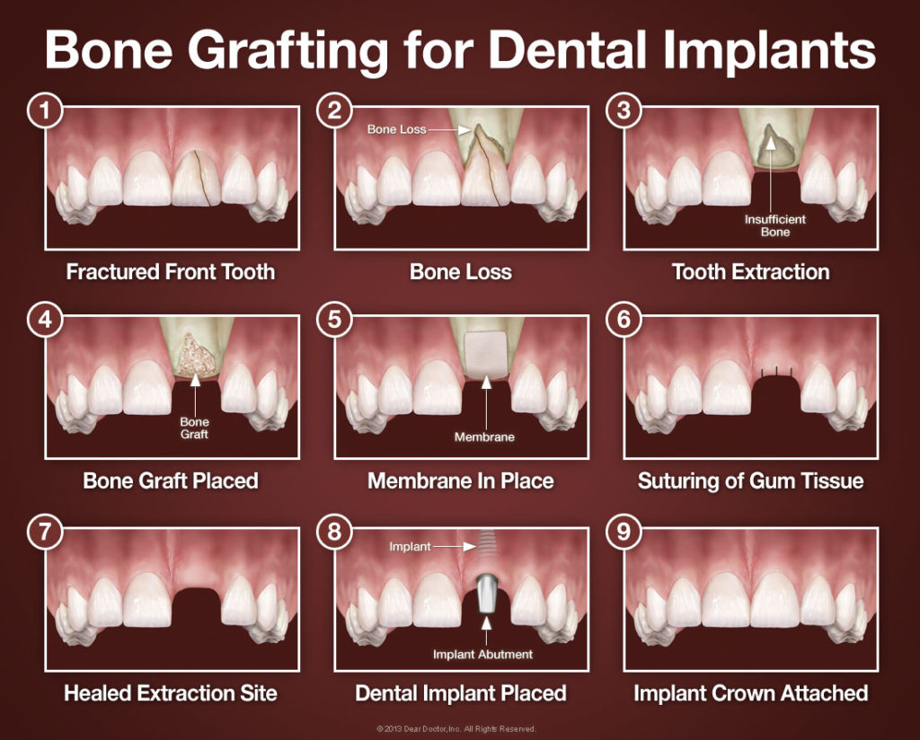 Bone Grafting for Dental Implants in Elkin, NC