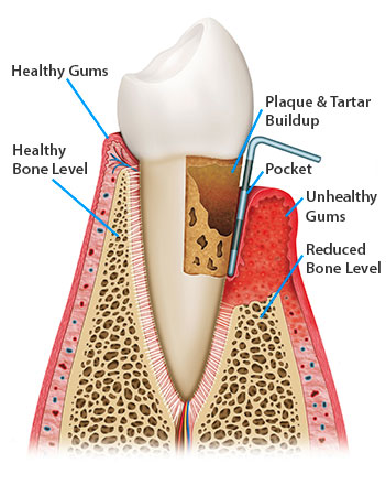 elkin, NC periodontal treatment