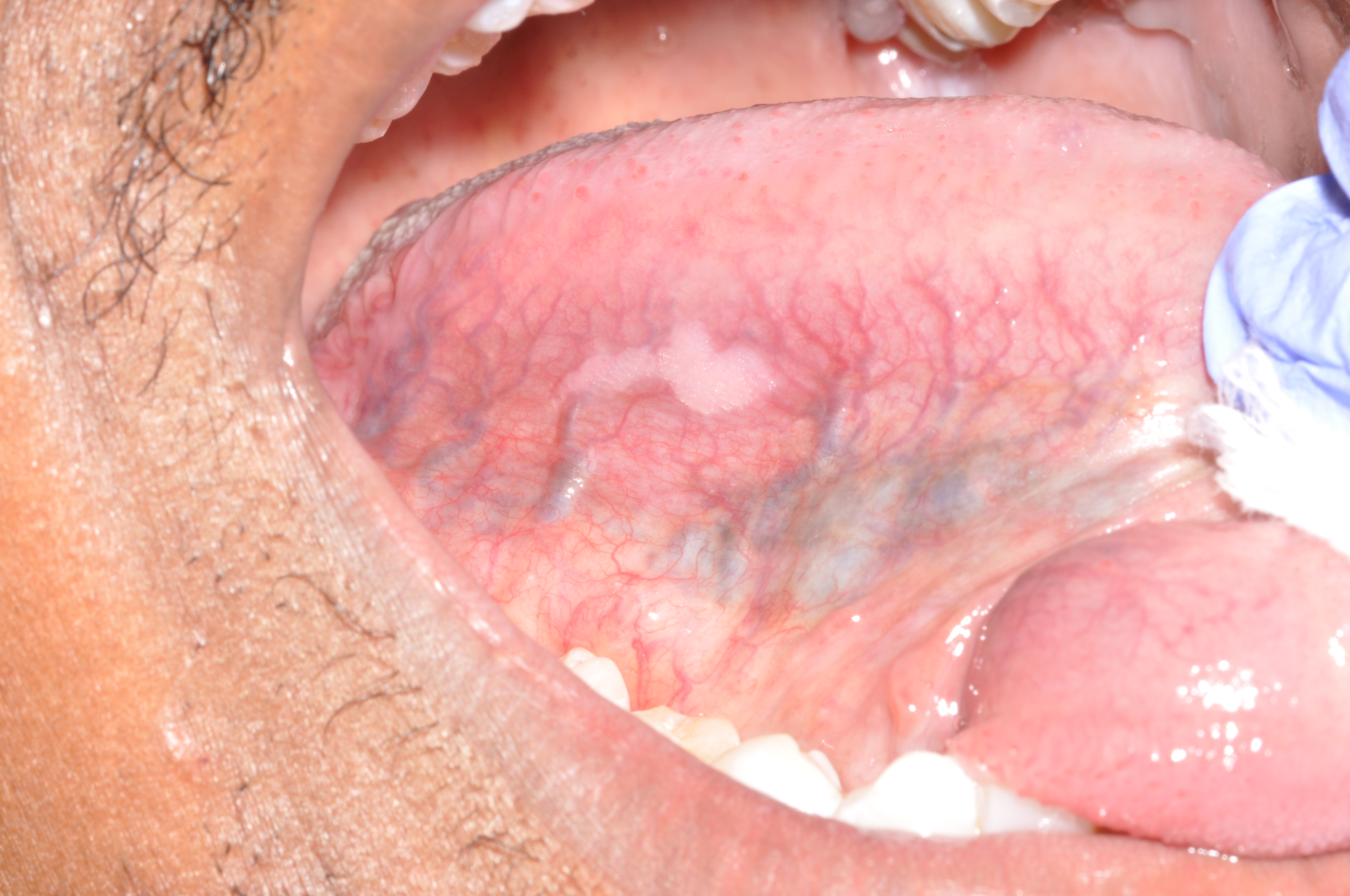 Sores on the tongue indicating early signs of oral cancer.