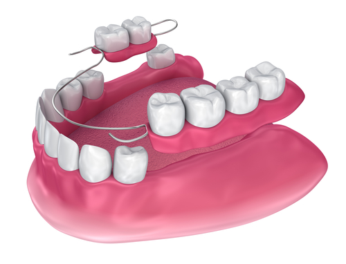 partial dentures in elkin, NC