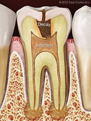 endodontics in elkin, NC