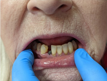 Before and after photos: dental implant treatment