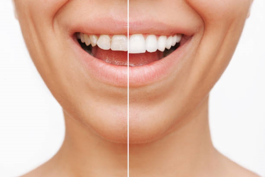 How to Care for Veneers: Tips From Your Dentist in Elkin