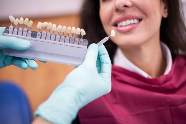 Why Is It Important to Care for Your Veneers?