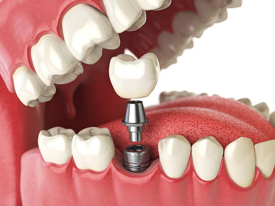 Dental Implants- Top Choice for Replacing Teeth in Elkin, NC.