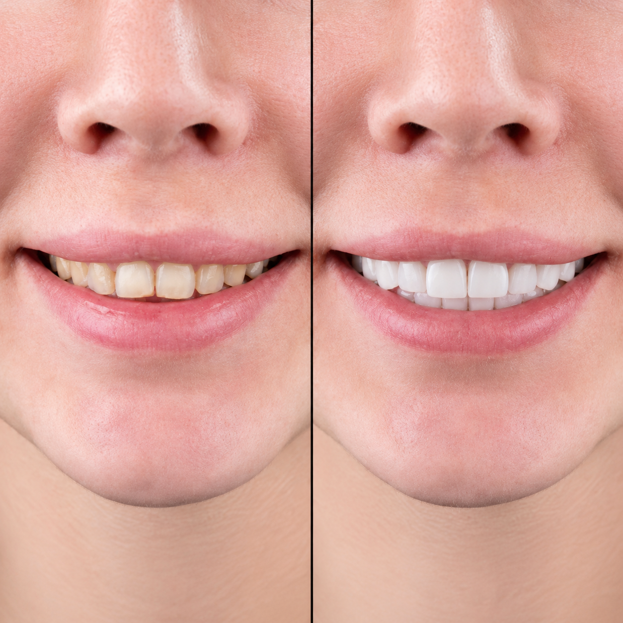 Before and after teeth whitening procedure.
